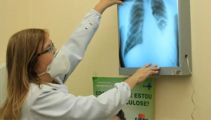  Baixo financiamento mundial ameaça combate à tuberculose 